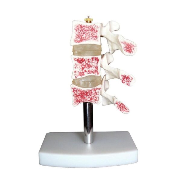 Osteoporoz Kesiti Modeli - Görsel 2